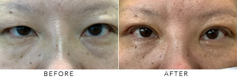 Asian Blepharoplasty Gallery