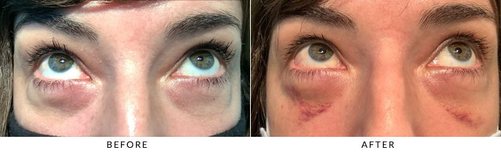 Lower Eyelid Blepharoplasty Before & After Photo - Patient 3